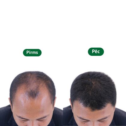 Vīrietis pirms un pēc matu transplantācijas
