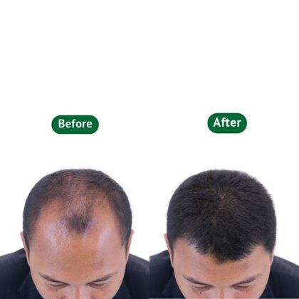 Man before & after hair transplantation