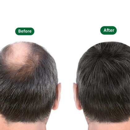 Before & after hair transplantation