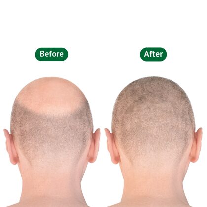 Man before & after hair transplantation behind picture