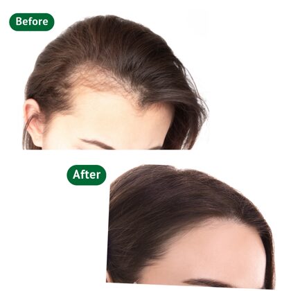 Woman before & after hair transplantation