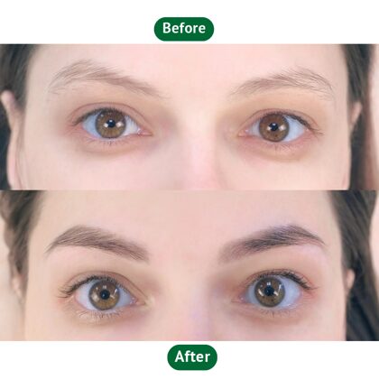 Before & after eyebrow transplantation