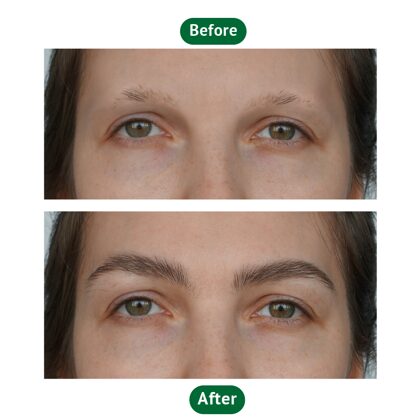Woman before & after eyebrow transplantation