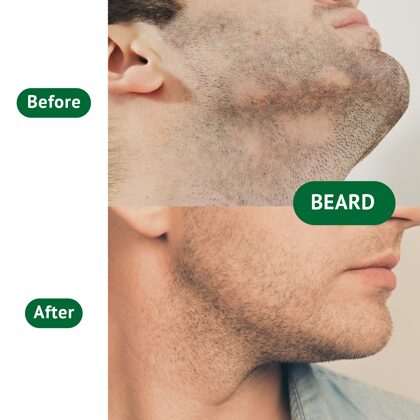 Man before & after beard transplantation