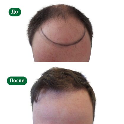 Лоб мужчины до и после пересадки волос