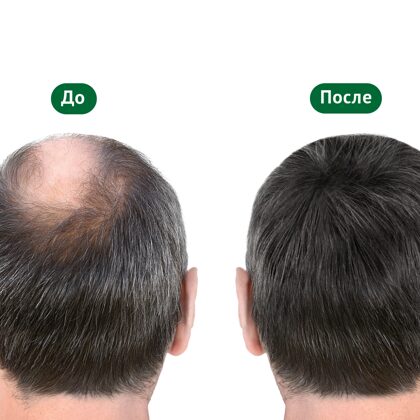 Затылок мужчины до и после пересадки волос 