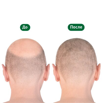 Мужчина до и после пересадки волос, вид сзади