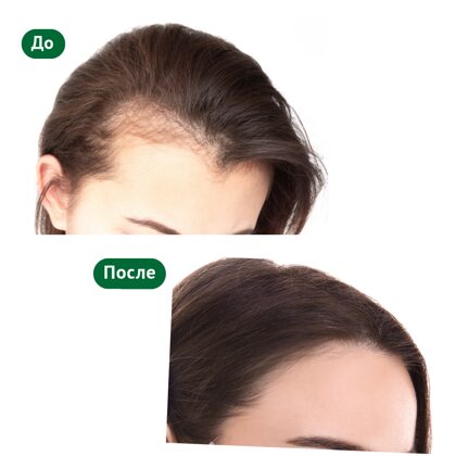 Женщина до и после пересадки волос
