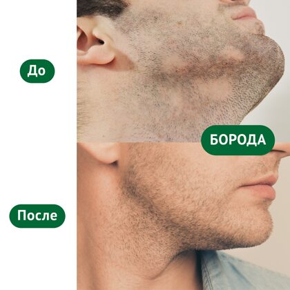 Мужчина до и после пересадки бороды