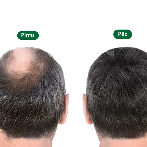Pirms/pēc matu transplantācijas