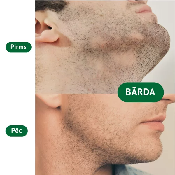 Bārdas transplantācija 