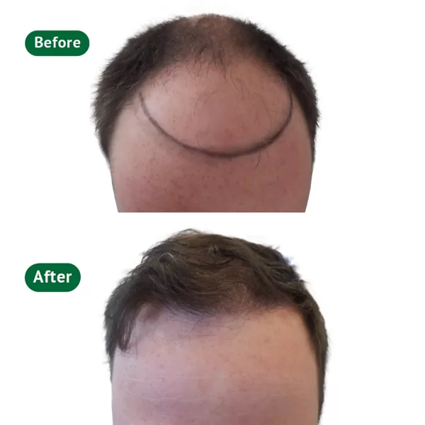 Man before & after hair transplantation front picture