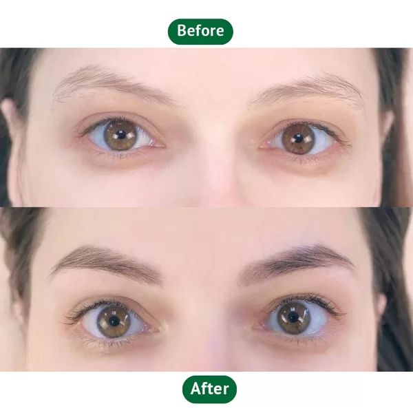 Before & after eyebrow transplantation
